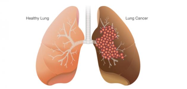 مراحل تطور مرض سرطان الرئة موضوع