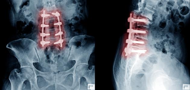 علاج انسداد عصب اليد موضوع