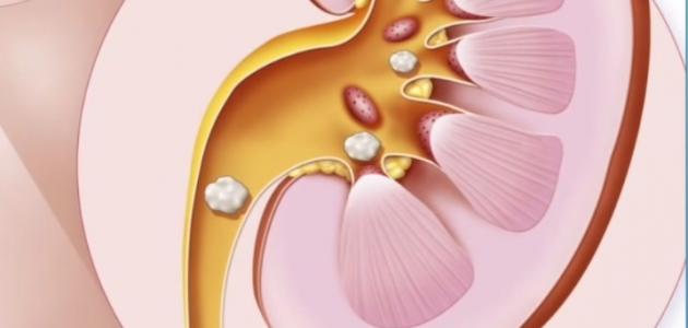 علاج حصوة الحالب فيديو موضوع