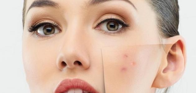 آثار الحبوب في الوجه وعلاجها موضوع